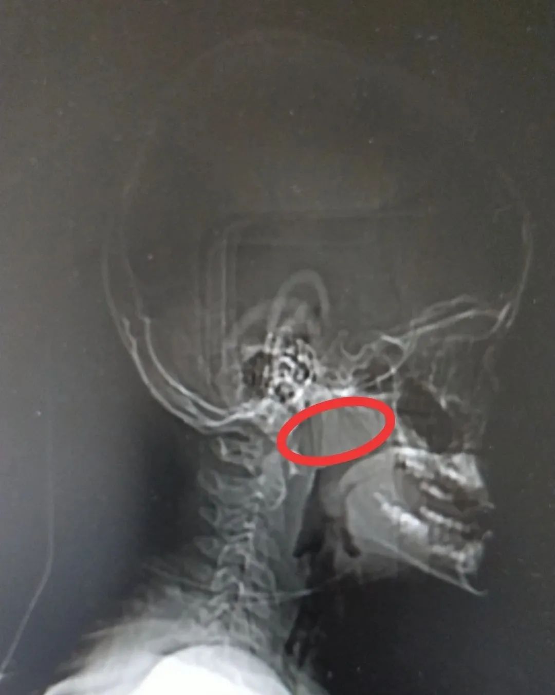 鼻炎的孩子7岁切掉腺样体,7岁小孩鼻炎腺样体肥大能治好吗