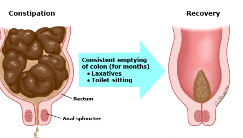 小女孩大便困难怎么办,小女孩大便干拉不出来怎么办