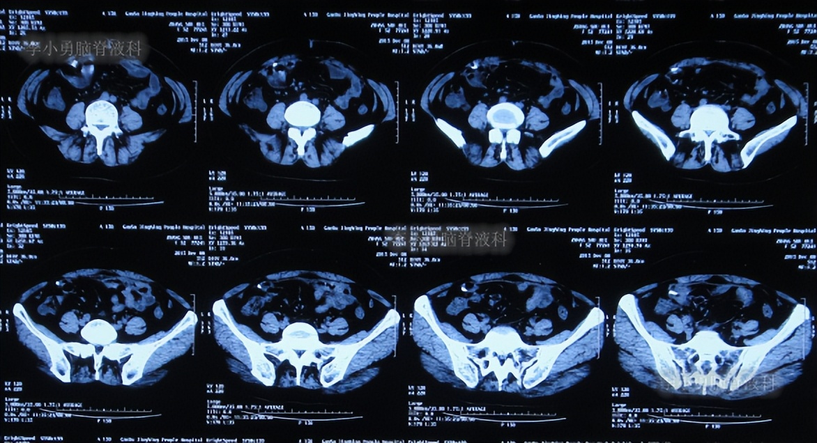 脑积水手术后4天还呕吐怎么回事,脑积水分流术后一直腹部疼痛