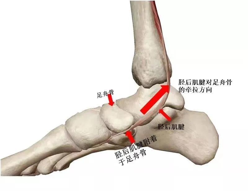 扁平足发病机制,扁平足诊断标准示意图