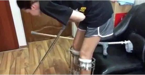 李亚诺断骨手术,断骨增高7.2厘米的李亚诺现状