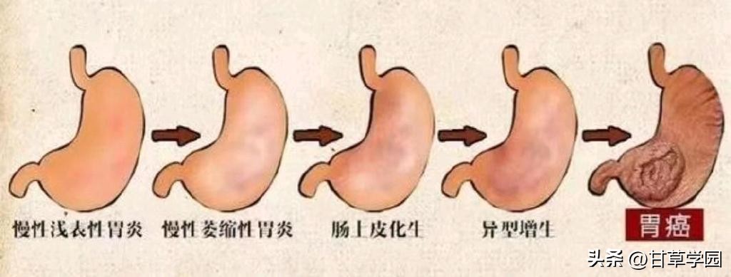 甘草学园|慢性萎缩性胃炎中医治疗