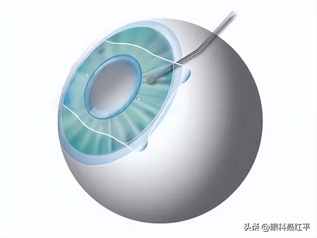 黄斑病变怎么预防,戒烟戒酒可以预防眼睛黄斑病变吗