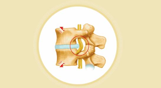 腰椎间盘4-5节突出最好治疗方法,预防腰椎间盘问题