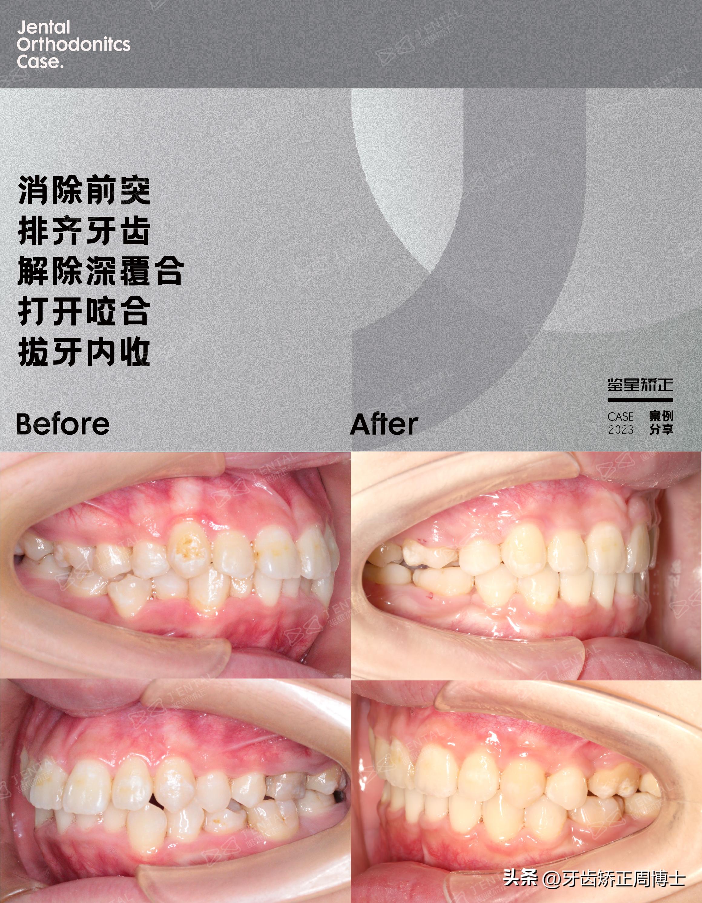 龅牙骨钉矫正演示,骨性龅牙打骨钉前后对比