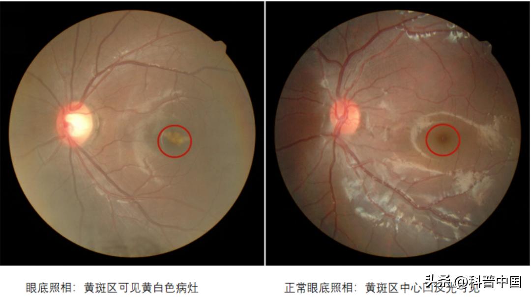 突然失明几秒钟是什么原因,眼睛莫名一只短暂失明原因