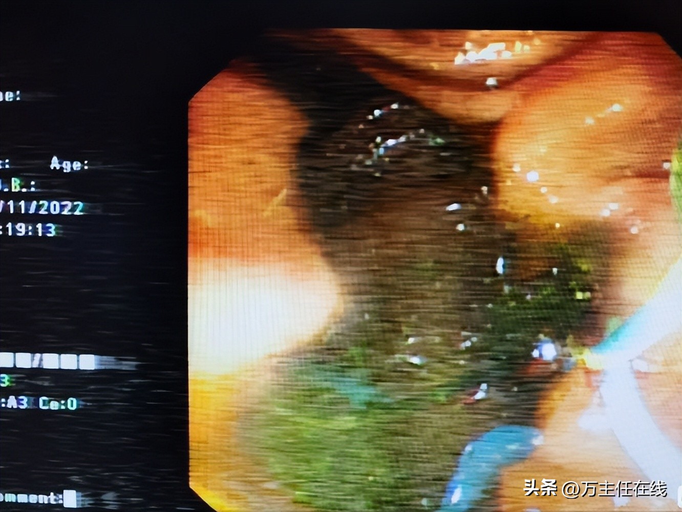 胆结石化脓性胆囊炎,妙手神针巧治疑难杂症