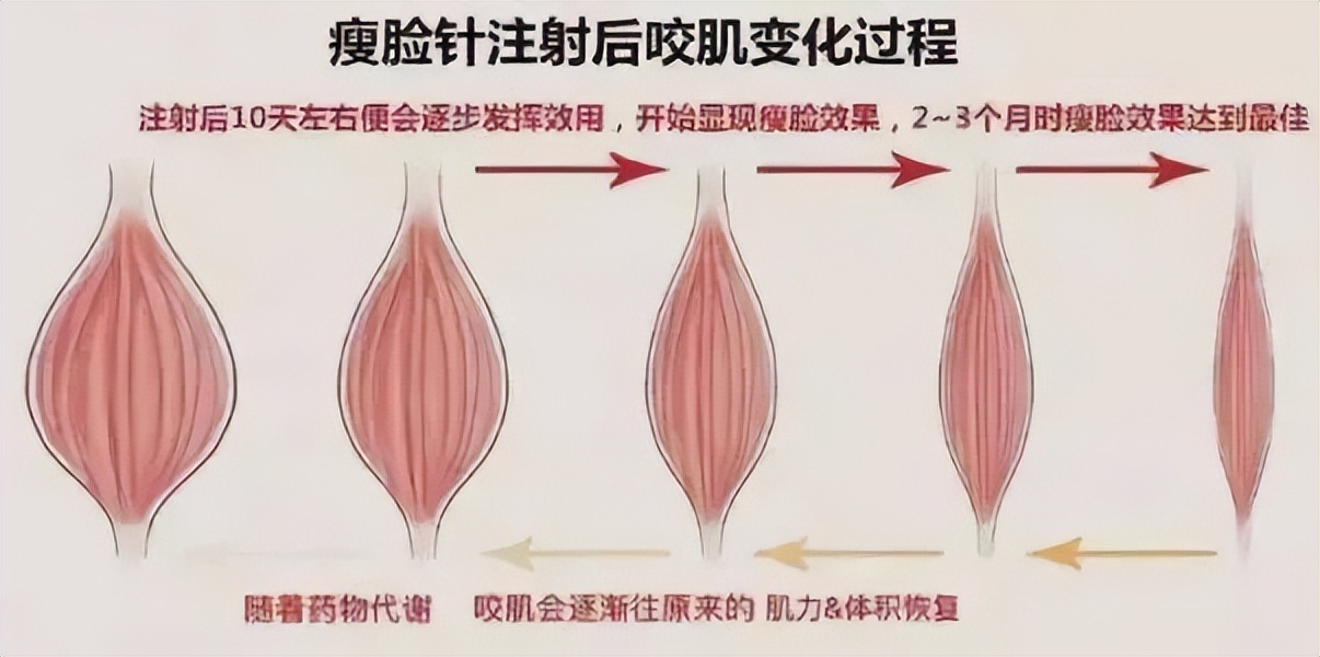 瘦脸针真的会瘦脸吗,瘦脸针真的有效果吗