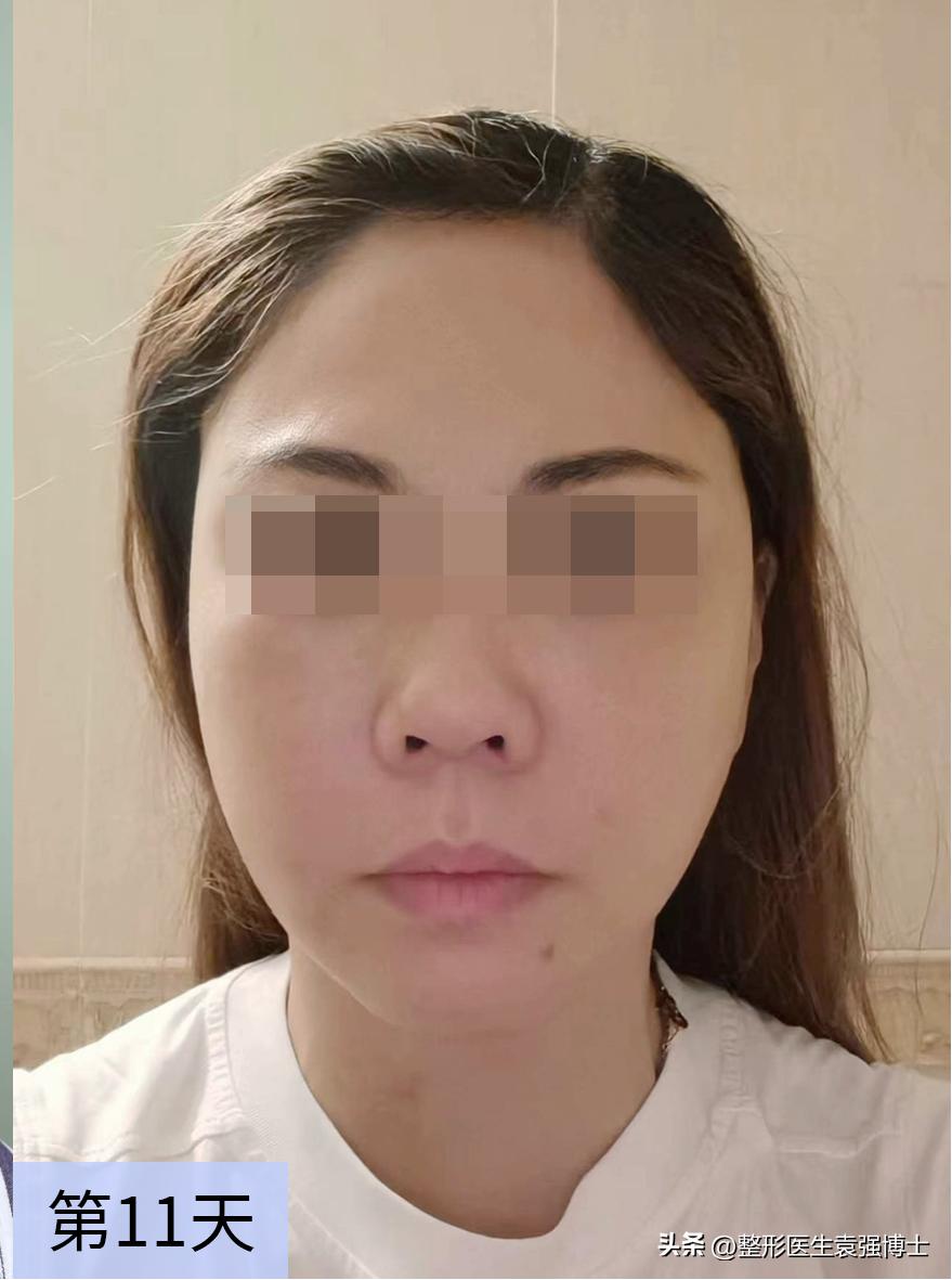 46岁肌肤松弛能做拉皮手术吗,46岁脸部下垂还能做拉皮手术吗