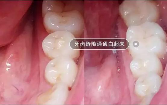 电动牙刷伤不伤牙齿,机械式电动牙刷伤牙齿吗