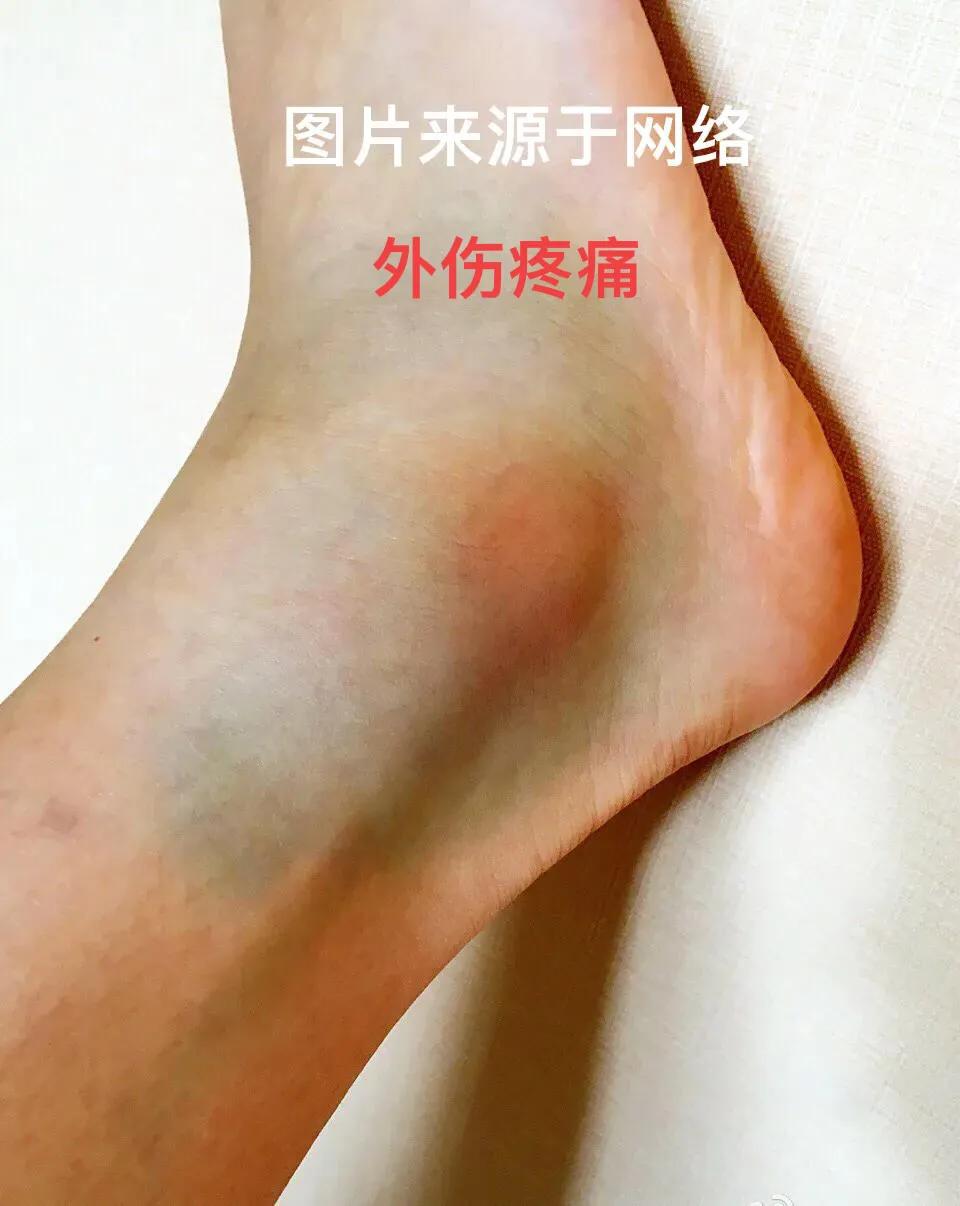 颈肩腰腿疼怎么选择膏药贴,颈肩腰腿疼痛选穴方法