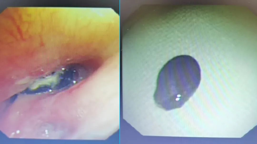 吃西瓜多了为什么咳嗽,西瓜籽吃了咳嗽是为什么