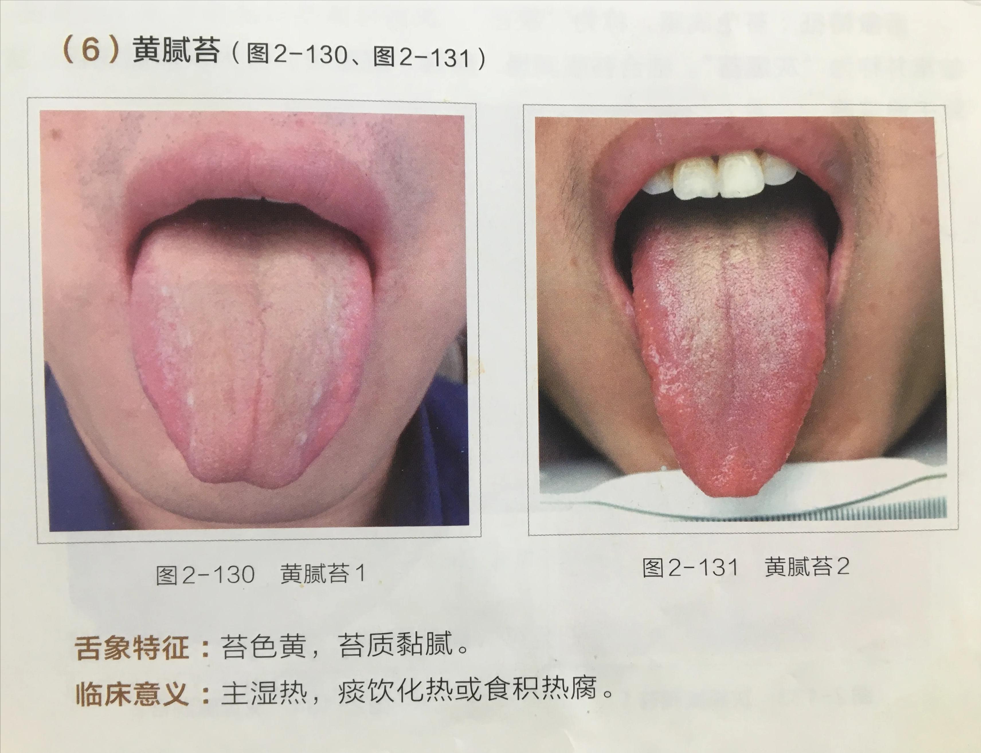 苔白舌诊与疾病对照图,舌诊中舌质红且有苔