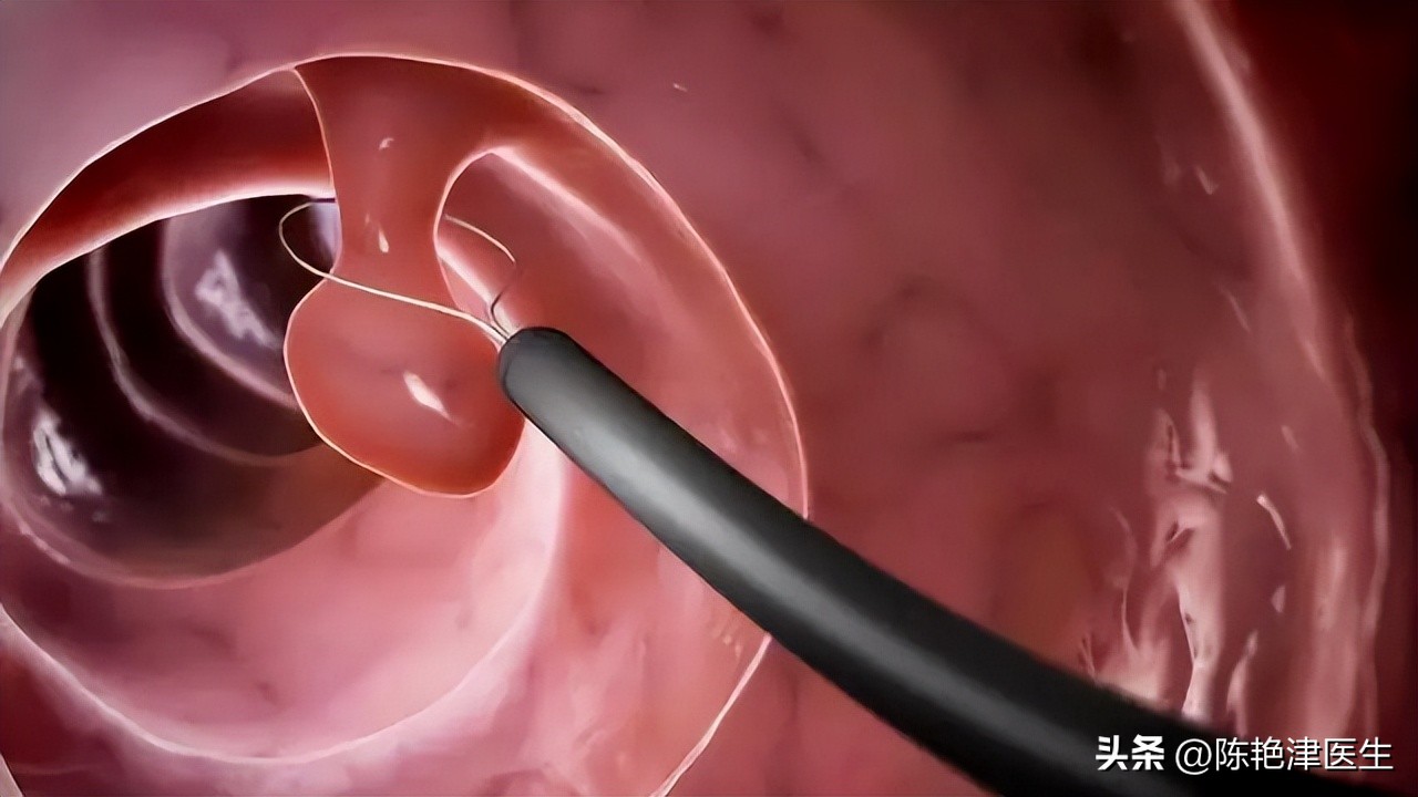 为什么不愿意做肠镜,为啥多数人不敢做胃肠镜