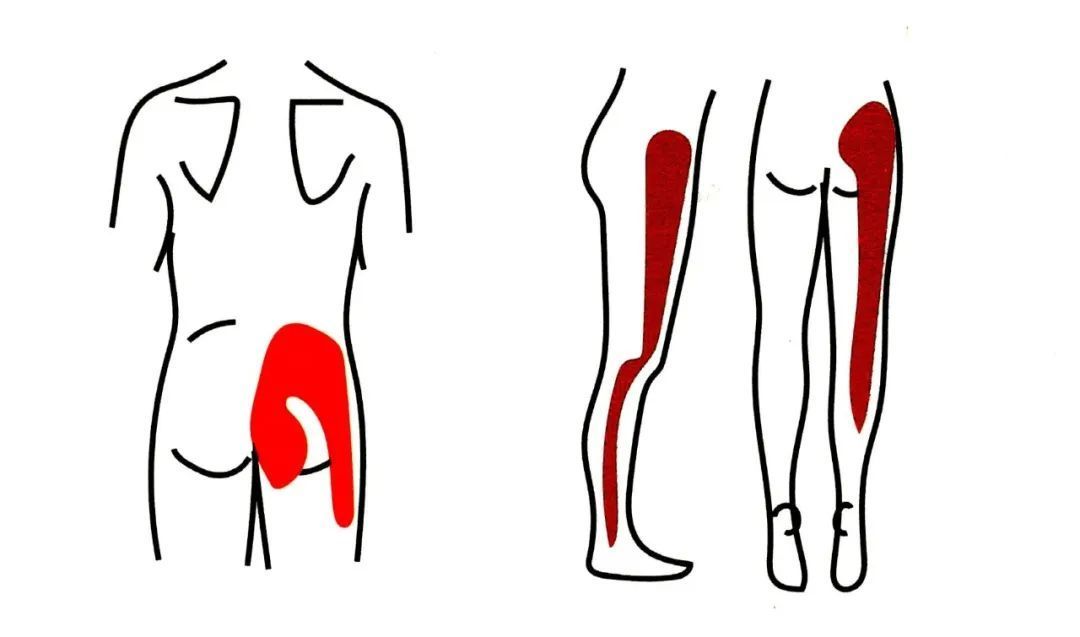 孕期缓解坐骨神经痛的最佳动作,腰椎间盘突出坐骨神经痛康复动作