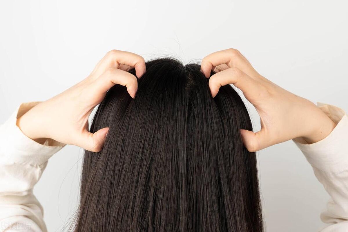 头发里有大片的头皮屑，这是怎么回事？