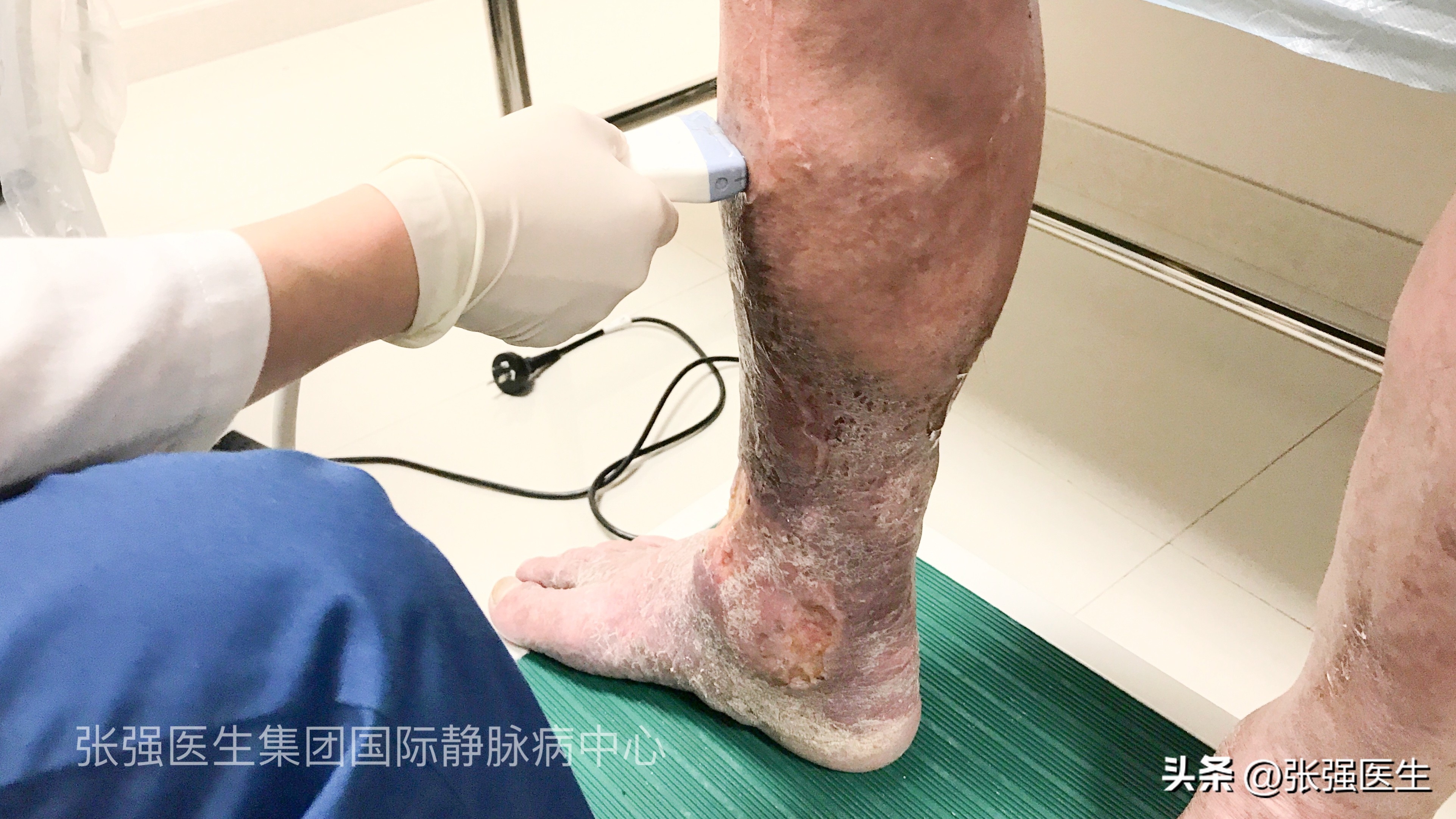 静脉曲张引起小腿肿胀如何治疗,静脉曲张小腿是非凹陷性水肿吗