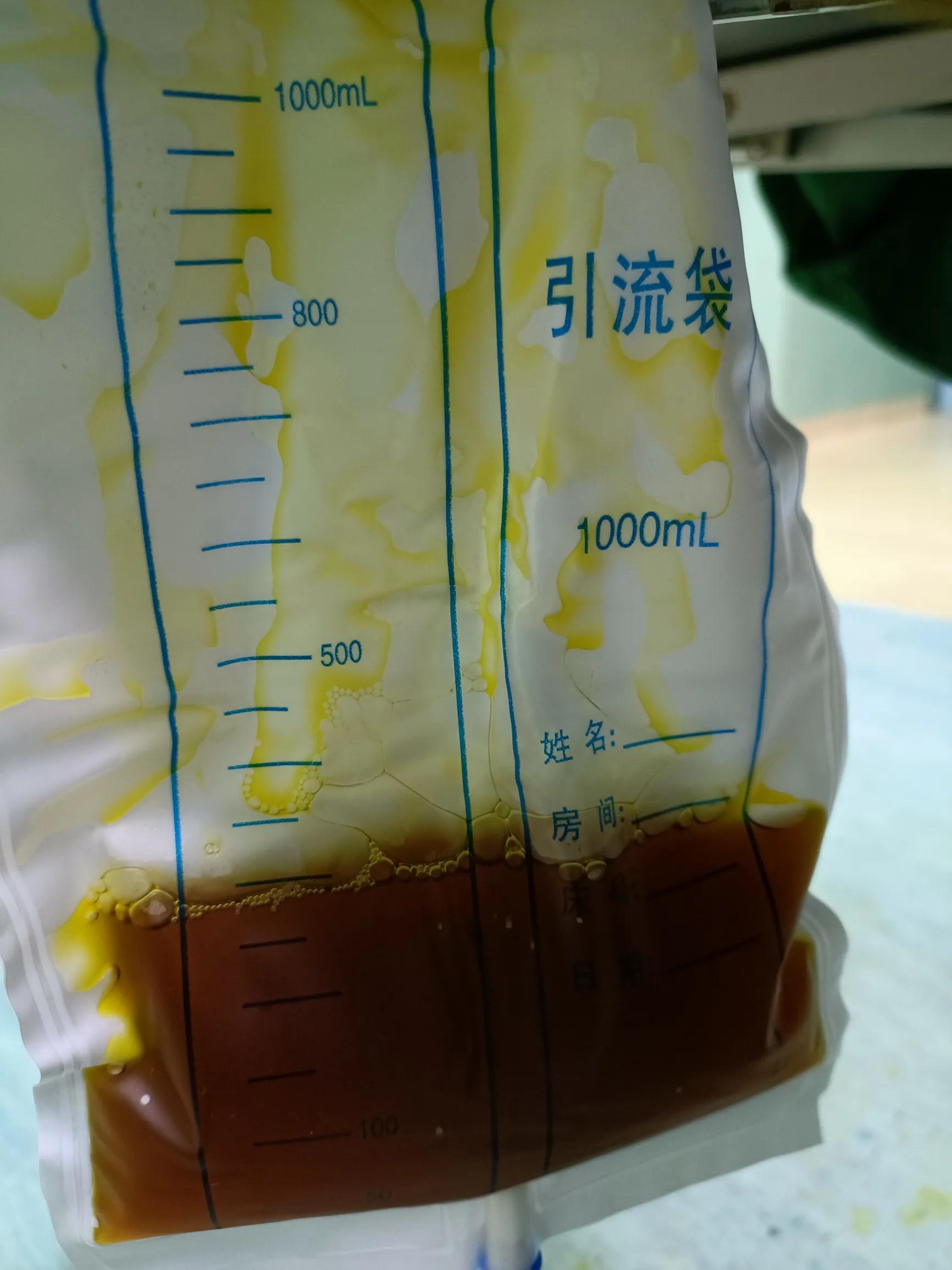 肿瘤患者尿液呈茶色,小便呈茶色尿常规正常