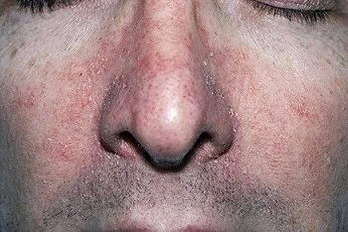 脸上脂溢性皮炎可以用999皮炎平吗,脸上起皮脂溢性皮炎该怎么办