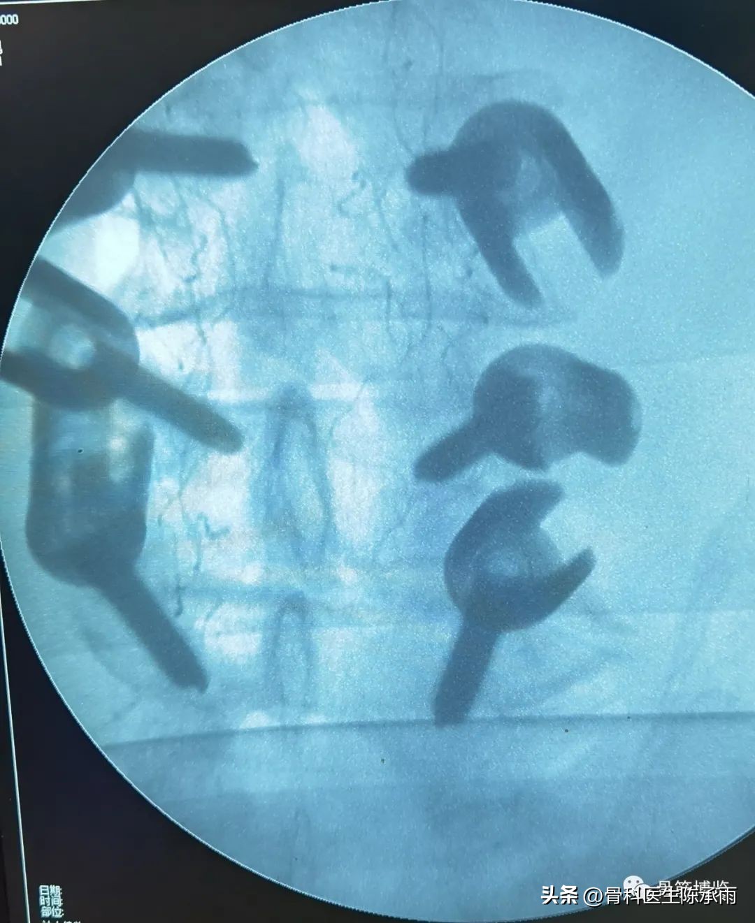 腰椎滑脱椎管狭窄手术后遗症,腰椎间盘突出椎管狭窄的手术