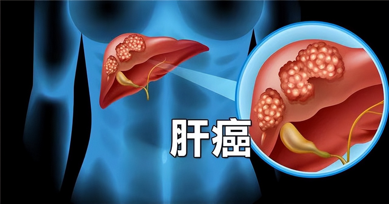 谷丙转氨酶高出多少是肝癌,谷丙转氨酶400谷草200会是肝癌吗
