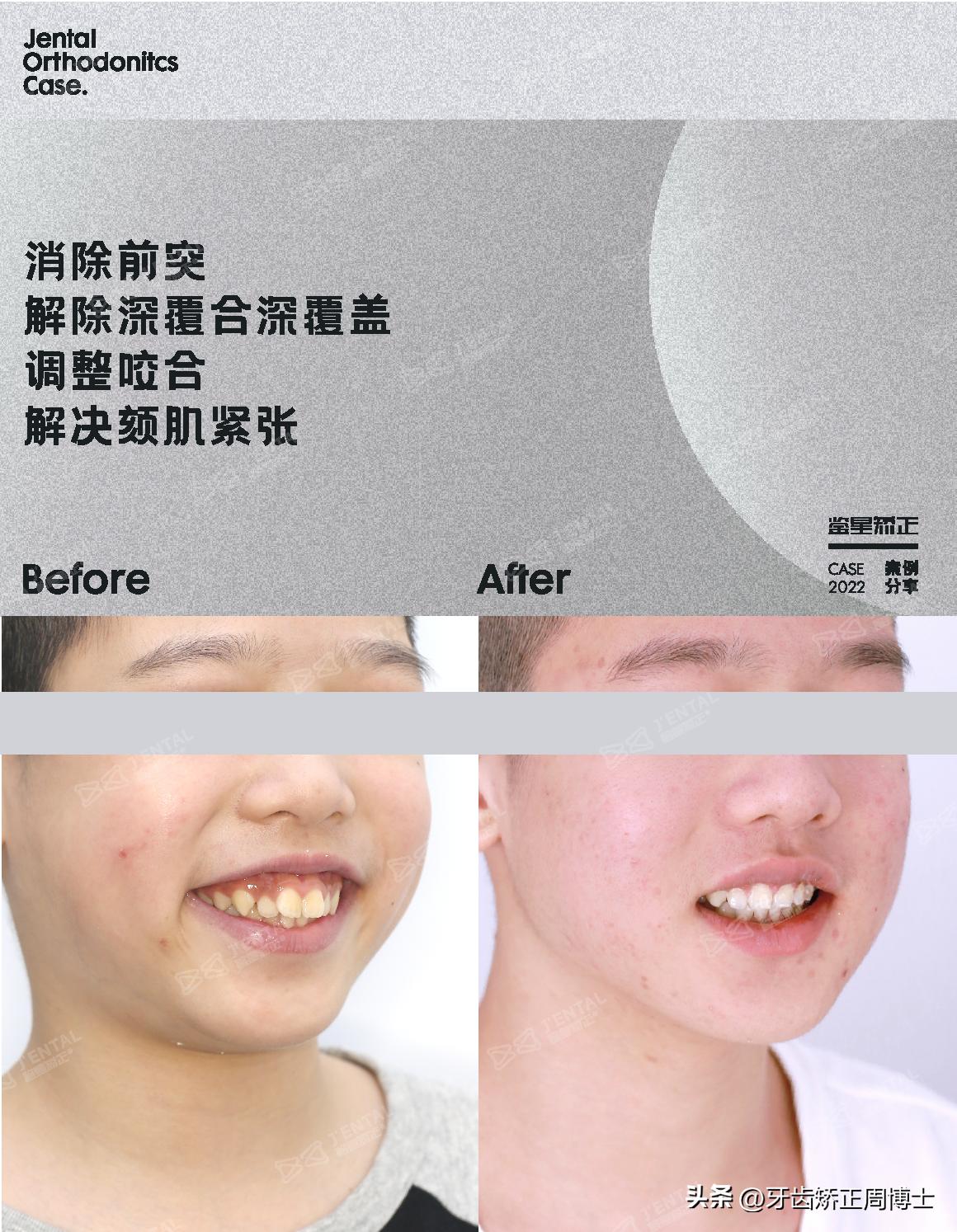 mrc戴上后不能闭上嘴怎么办,mrc矫正能用到几岁