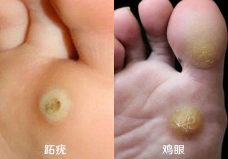 脚底板爱出汗怎么解决,脚底板爱出汗是什么原因造成的