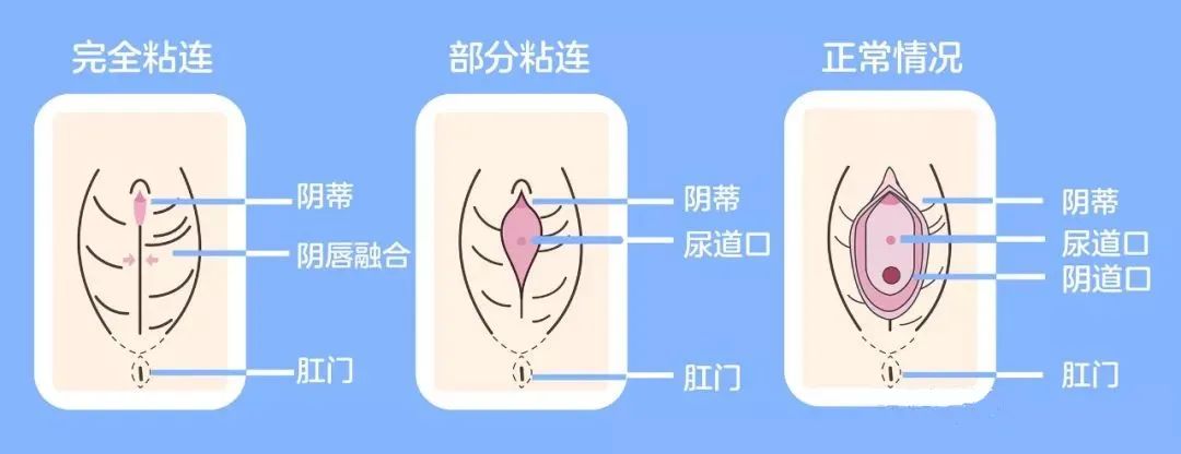 女婴也需要注意妇科疾病,六个月的女婴