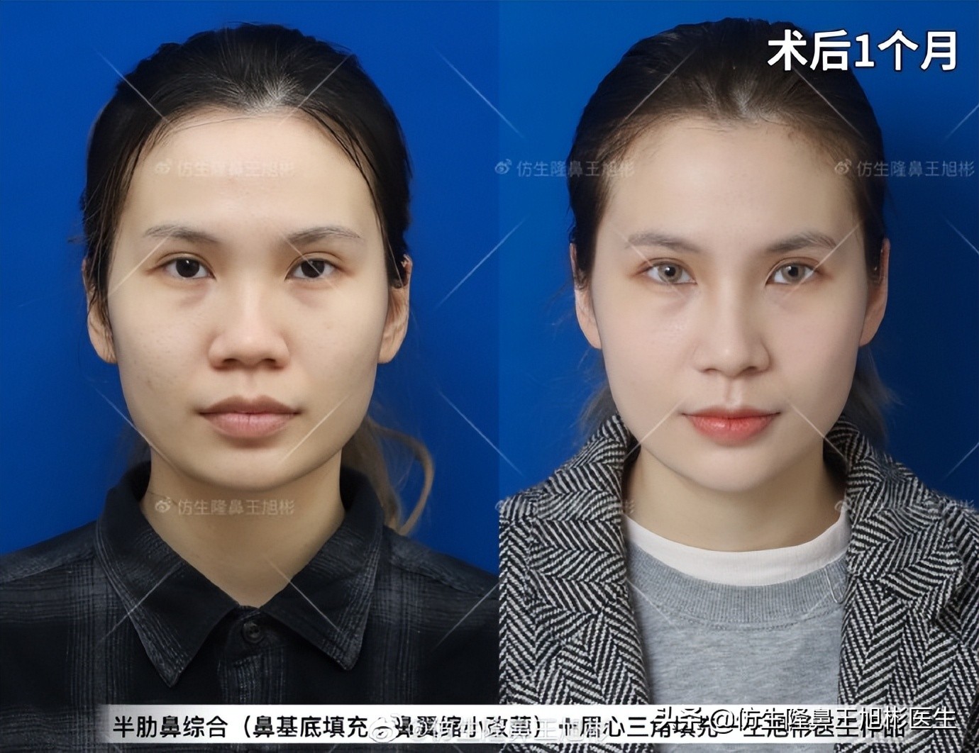 做一次鼻头缩小要多少钱好,可以只做鼻头缩鼻翼吗