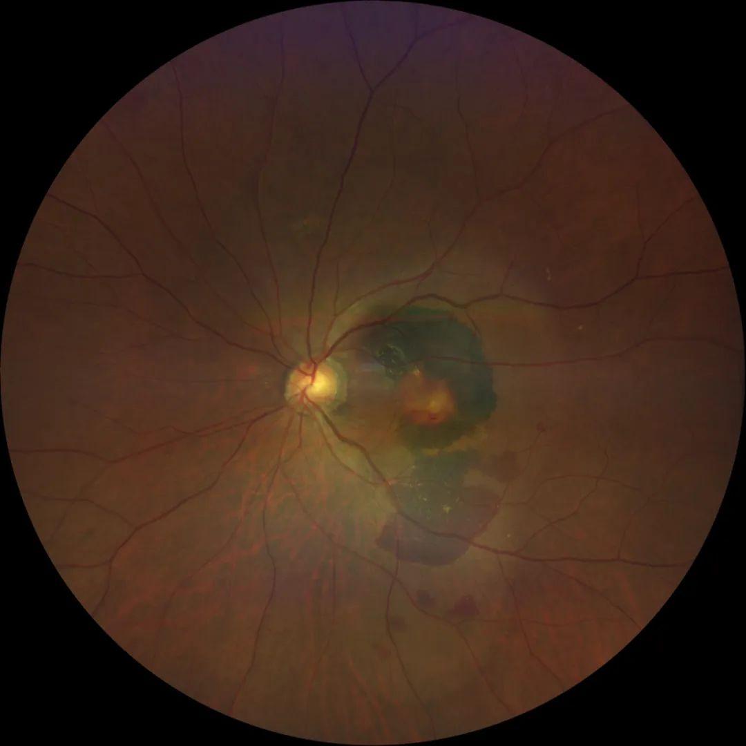 视力模糊眼前有黑影,眼前看到黑影滚动视力差怎么回事