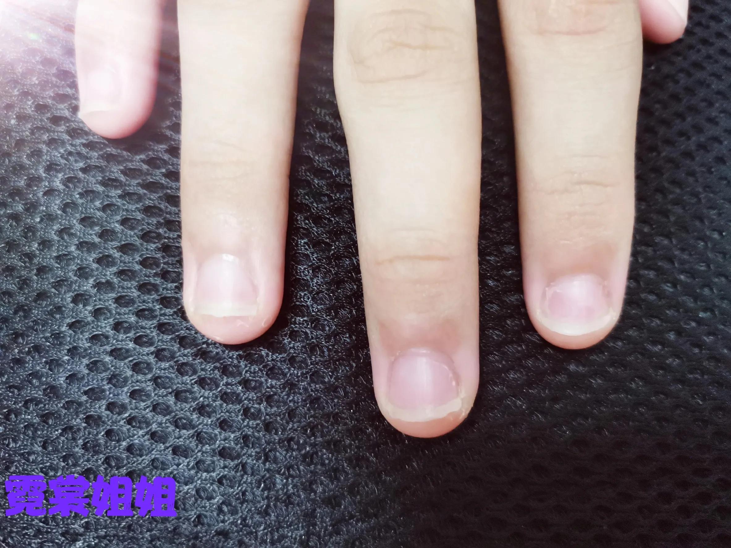 一招治好孩子爱啃指甲的毛病