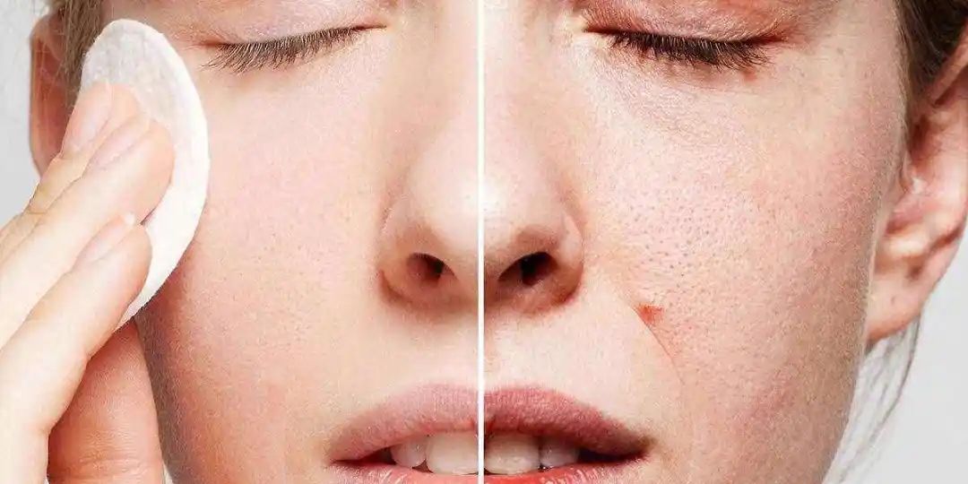 解决毛孔粗大的方法收藏起来,解决毛孔粗大的秘籍你值得拥有