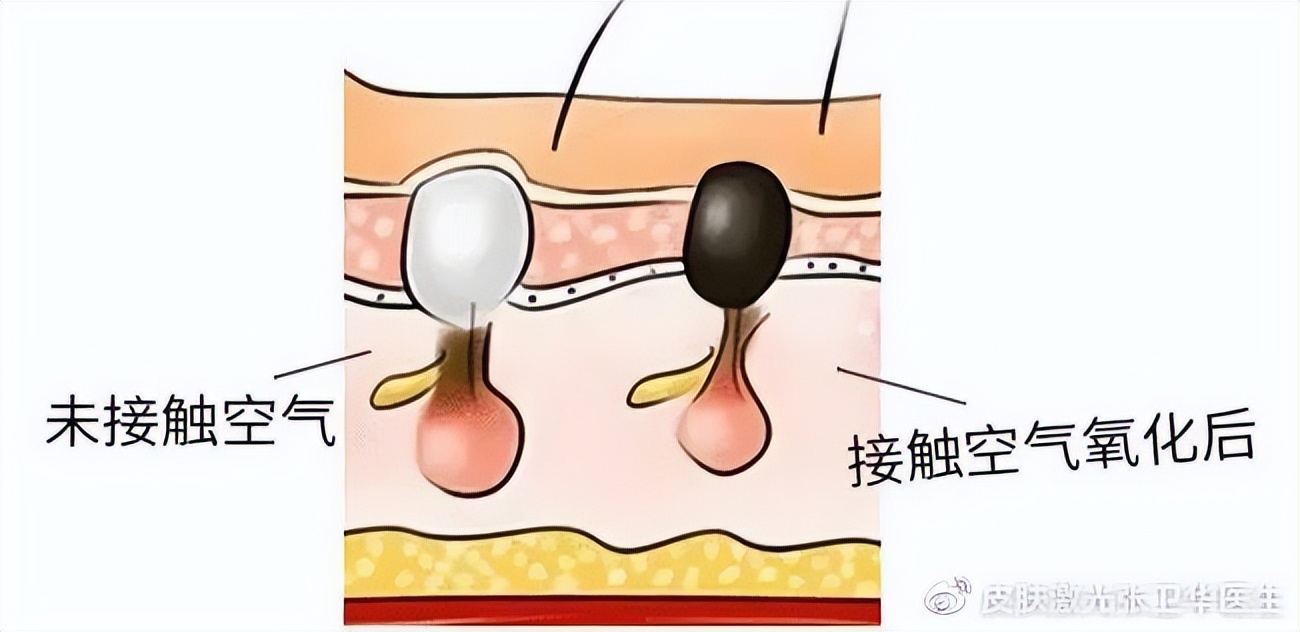 痘印痘坑要怎么去掉才能不留疤呢,为什么你脸上会长痘痘