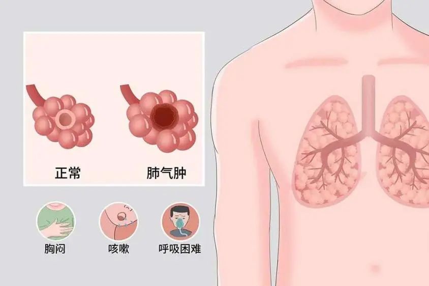 肺气肿和慢阻肺的区别是什么,肺气肿和慢阻肺是一回事