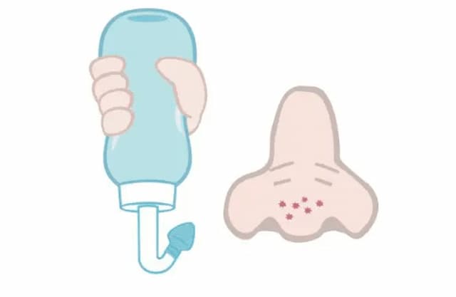 鼻炎鼻塞常年不通气小妙招,鼻炎鼻子堵塞不通气用什么特效药