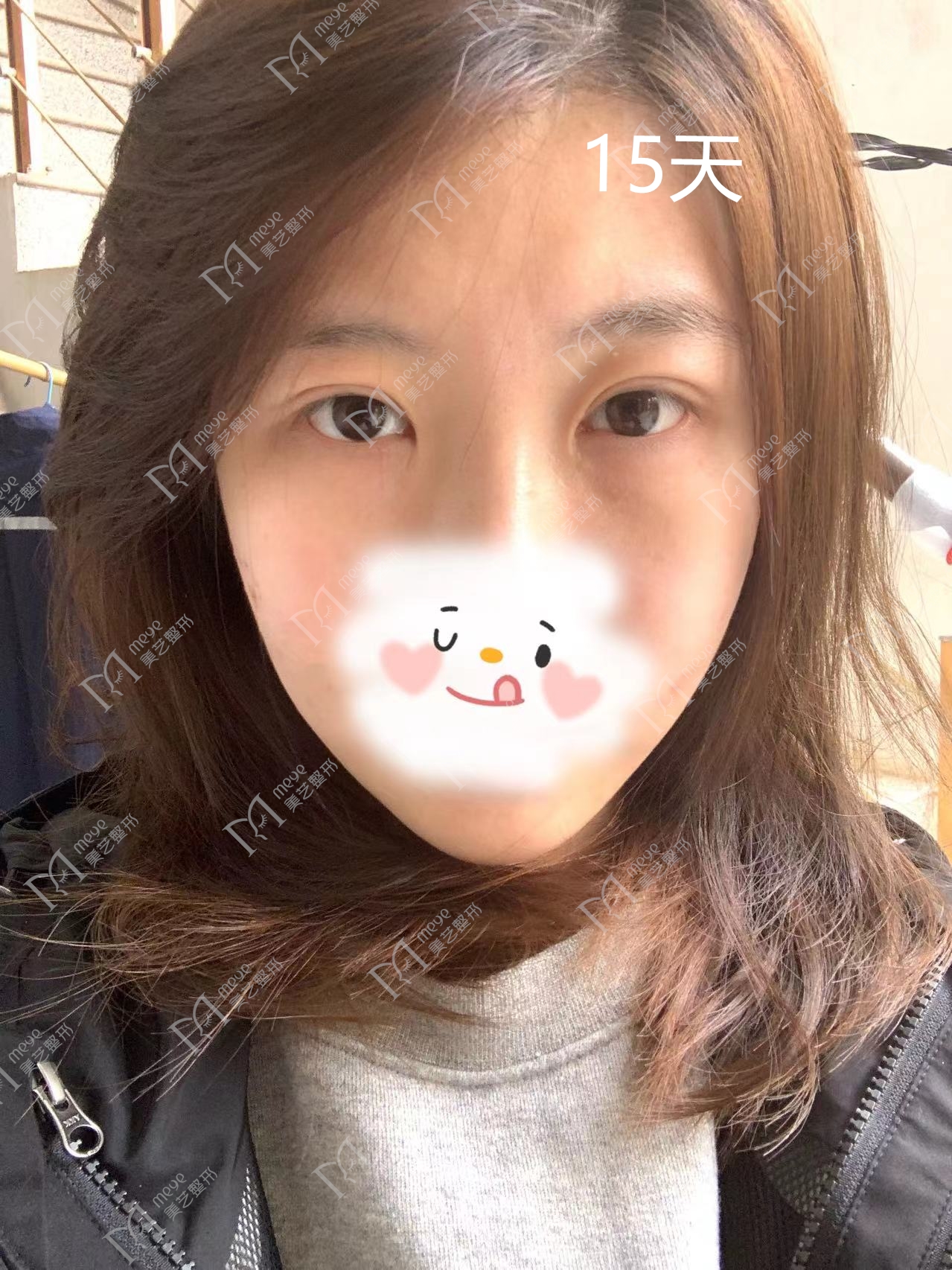 郑州修复双眼皮成功案例,郑州双眼皮修复全过程