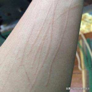 麻疹病人的治疗原则,荨麻疹吃中药有什么要忌口的