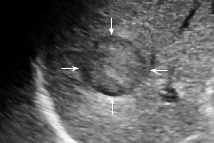 肝内血管瘤和肝癌超声怎么区分,肝占位病理检测项目