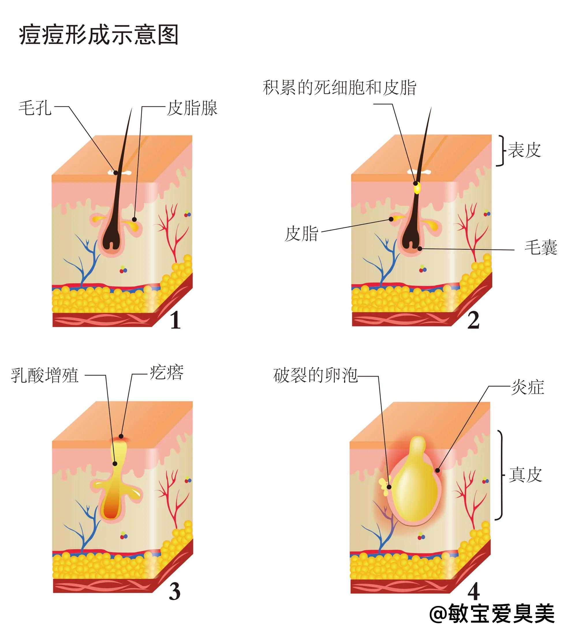 皮肤痘痘粉刺,各种皮肤痘痘问题讲解