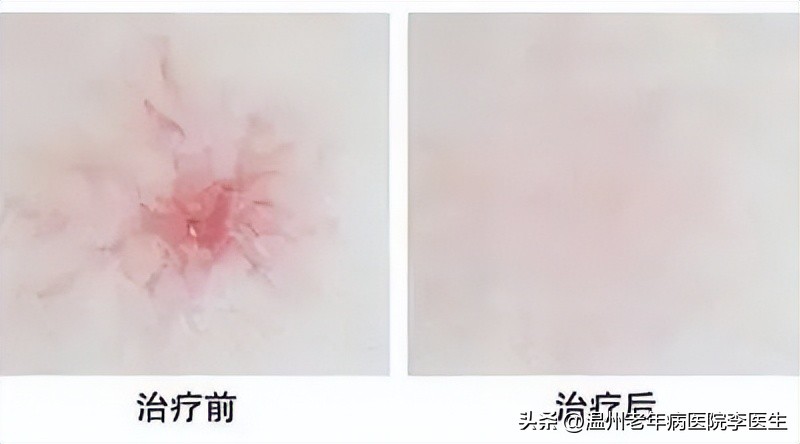 淡斑超光子,美白嫩肤光子