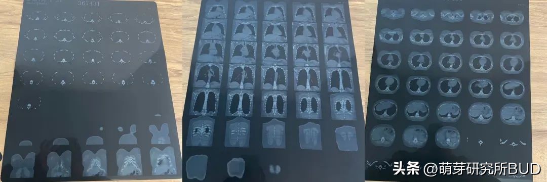 阳后要不要拍肺部CT？我用我的亲身经历告诉你，希望你永远用不上