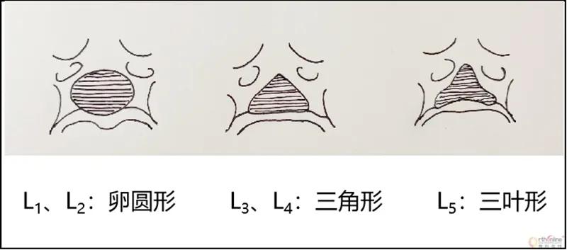 腰椎间盘突出1.7厘米做微创可以吗,腰椎间盘突出微创3d手术恢复视频