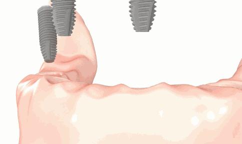 牙齿缺失后不补对身体有哪些伤害,牙齿缺失的危害一定要看完