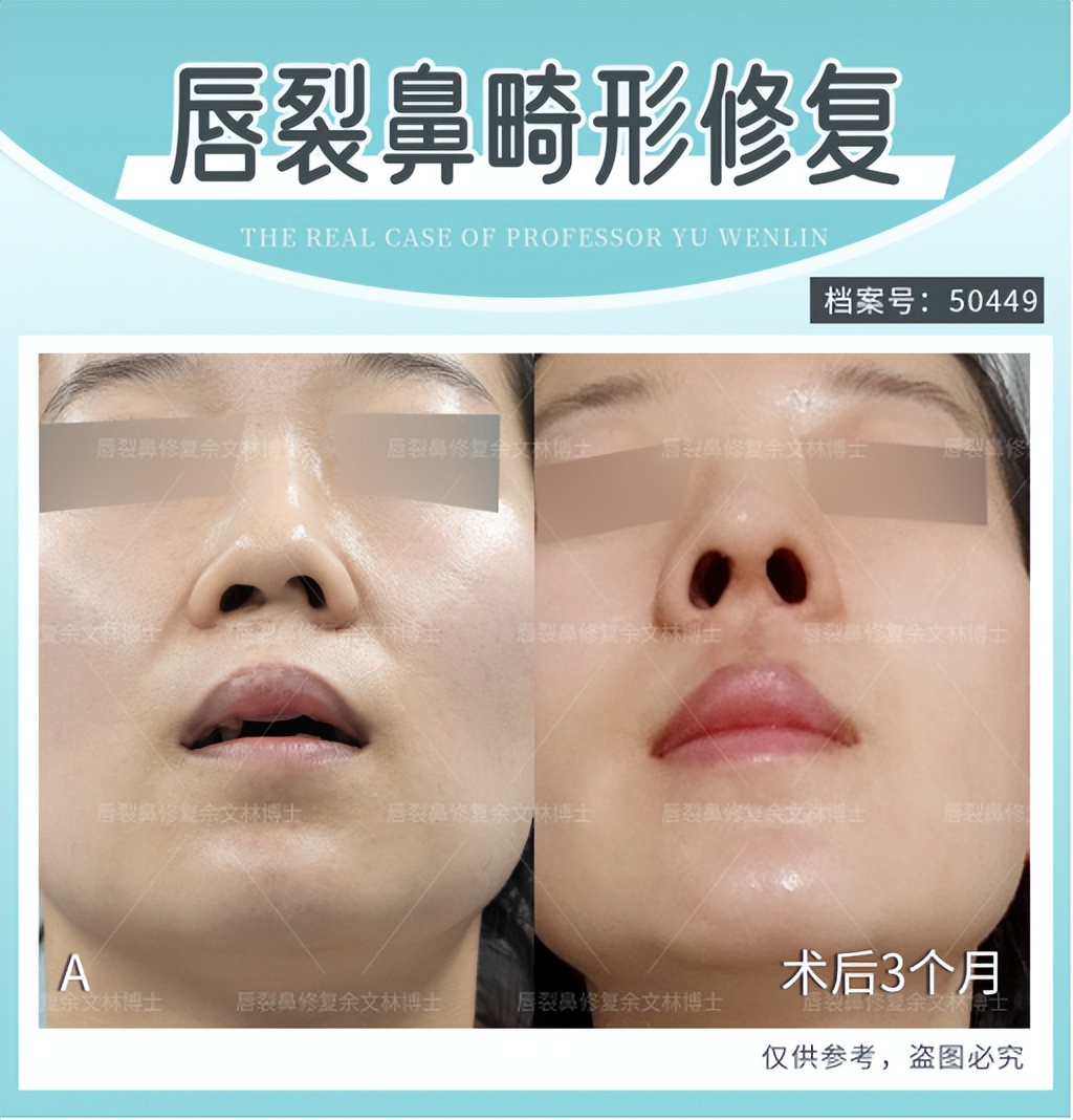 唇裂手术红唇裂开会自动愈合不,唇裂手术后伤口一直红怎么办