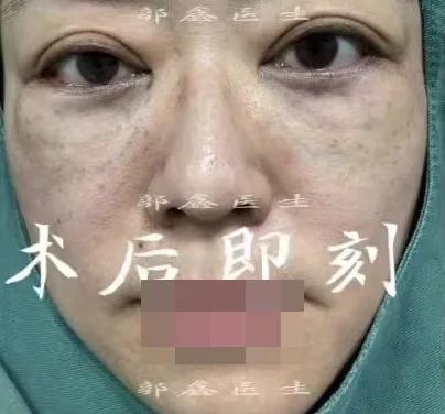 北京做眼袋手术大概需要多少钱,到正规大医院做眼袋手术有风险吗