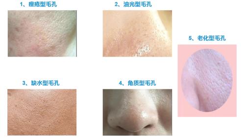 毛孔堵塞导致的爆痘应该怎么办,毛孔堵塞长痘图片