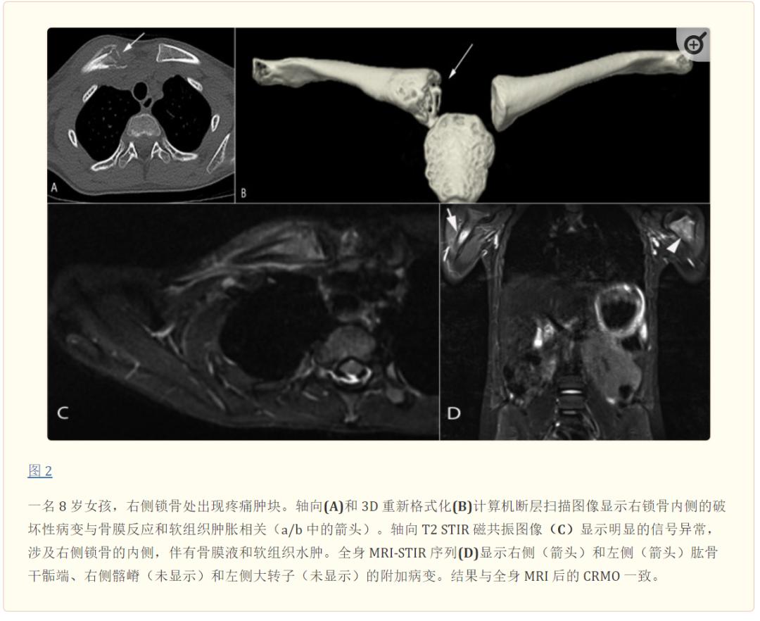 慢性骨髓炎症状,慢性复发性多灶性骨髓炎