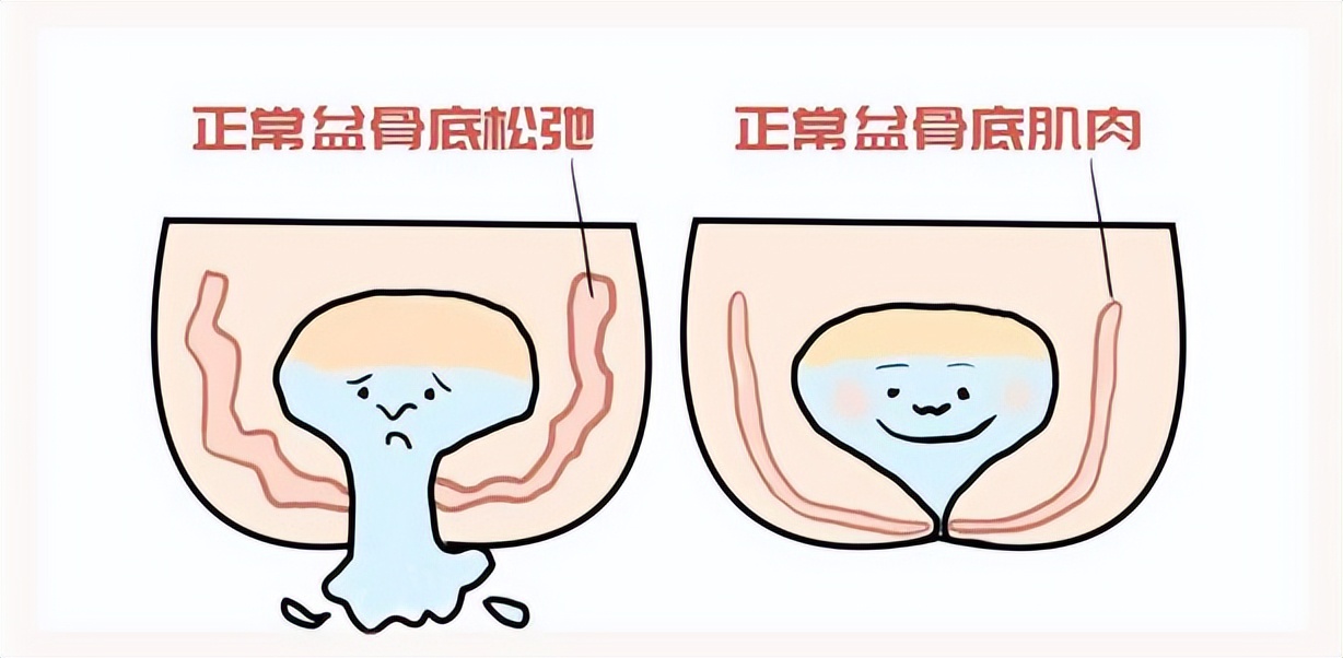 产后修复盆底肌神器,产后盆底肌修复神器来了