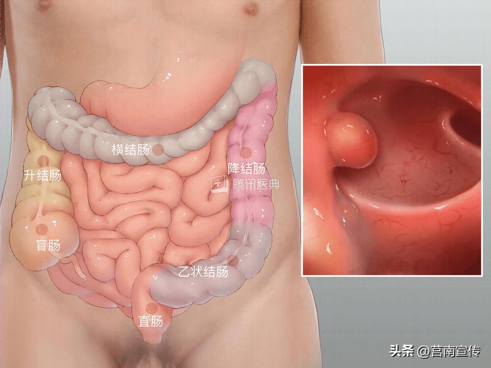 发现息肉，离癌有多远？