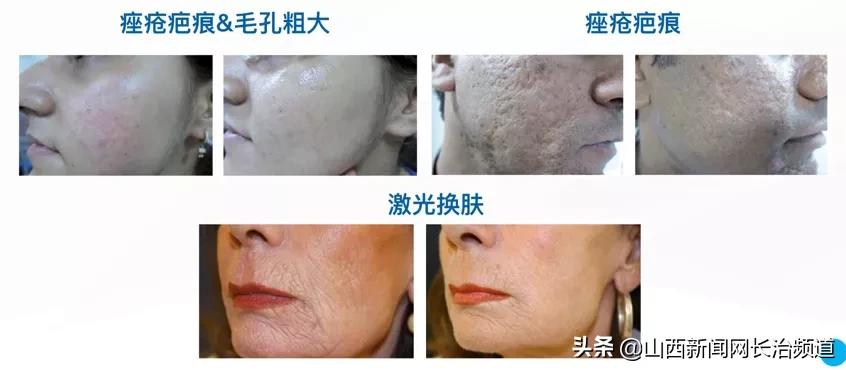 长治第二医院医疗美容科毛孔粗大,长治市第二人民医院治疗痘坑
